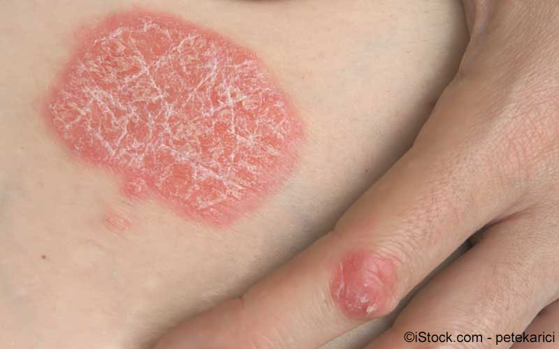 Psoriasis Rehakliniken